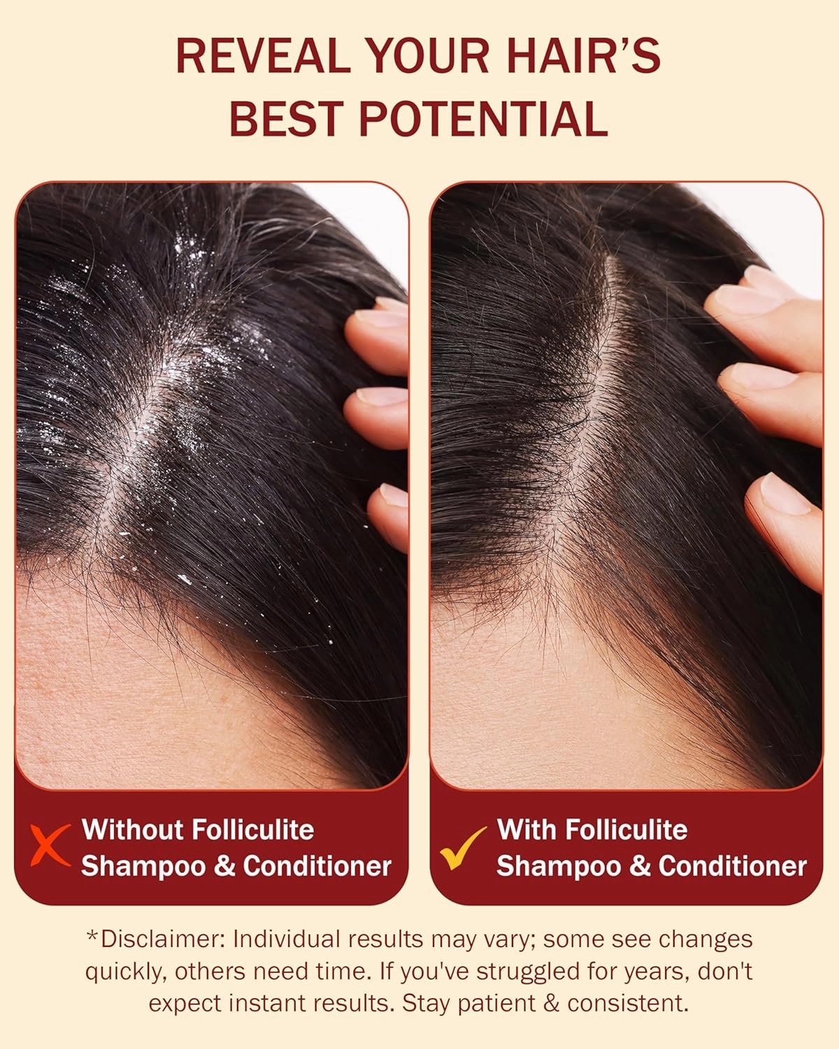 Folliculitis Shampoo and Conditioner Set, Made with 3% BHA, Salicylic Acid, Aloe Vera & Tea Tree Oil - Clarifying Shampoo for Buildup and Dry Itchy Scalp Acne